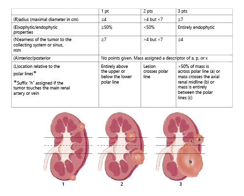 Fig. 1. RENAL is the abbreviation of (R)adius (scores tumor size as maximal diameter), (E)xophytic/endophytic properties of the tumor, (N)earness of the deepest portion of the tumor to the collecting system or sinus, (A)nterior (a)/posterior (p) descriptor, and the (L)ocation relative to the polar line. Of the 5 components, 4 (R.E.N.L.) are scored on a 1, 2, or 3-point scale. The fifth descriptor (A) is a suffix which describes the mass as primarily located anterior (a) or posterior (p) to the coronal plane of the kidney. The suffix x is assigned to the tumor if an anterior or posterior designation is not possible. Polar lines (solid lines) and axial renal midline (broken line) are depicted on each sagittal view of the kidney. Numbers 1–3 represent points attributed to each category of tumor [19].