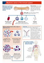 Preview of Summary Sheet 'Myeloma: Cancer of the Immune System'